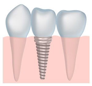 tooth implant dentistry with a Charlotte dentist